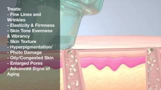 Hydrapeel Treatment Explained [upl. by Mcgee123]