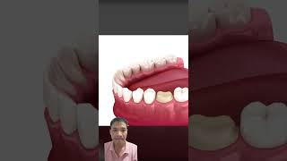 Gentle Dental Care ASMR Cavity Removal and Crown Replacement asmr dentition shorts [upl. by Annoyik]