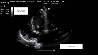 Endocardite Infecciosa  Infective Endocarditis  vegetations on echocardiography [upl. by Ertemed]