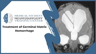 Treatment of Germinal Matrix Hemorrhage [upl. by Anabelle]