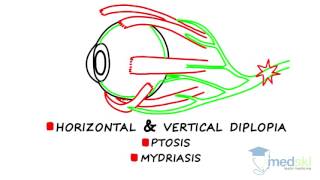 Ophthalmology – Diplopia By Martin ten Hove MD [upl. by Norward]