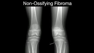 NonOssifying Fibroma 1 [upl. by Feltie]