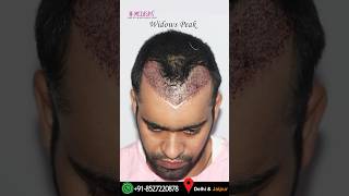 The best Hair Transplant Results in India by Dr Suneet Soni at Medispa Hair Transplant Centre [upl. by Sibby594]