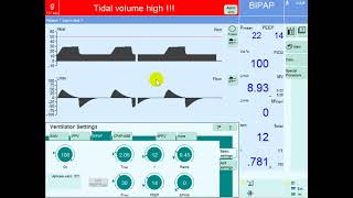 Optimizing Oxygenation on Mechanical Ventilation Strategies for Improving MAP in Hypoxemic Patients [upl. by Daniella]