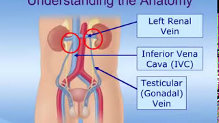 How do varicoceles cause male infertility  Dr Vasan S S  Varicocele Causes  Manipal Hospitals [upl. by Syned138]