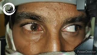 Phlyctenular conjunctivitis [upl. by Sollars]