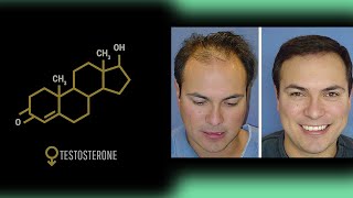 Is Testosterone Anabolic to Scalp Hair Growth [upl. by Koby]