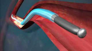 Cardiology  Stent Deployment Procedure [upl. by Atis]