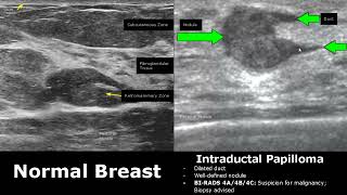 Breast Ultrasound Normal Vs Abnormal Image Appearances Comparison  BIRADS Classification USG [upl. by Arezzini]