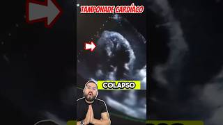 Derrame pericárdico que condiciona TAMPONADE 🫀 emergency [upl. by Laddie]