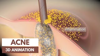 Acne basics  Pathophysiology amp Treatment  3D Animation [upl. by Ardnasirhc]