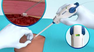 MANTA® Vascular Closure Device Deployment [upl. by Milstone]