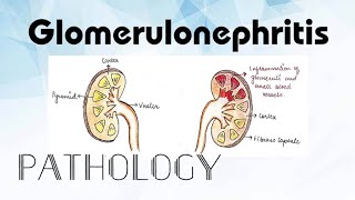 Glomerulonephritis Pathology [upl. by Analah360]