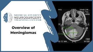 Overview of Meningiomas [upl. by Jeramie]