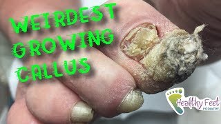 Weirdest Growing Callus by Dr Binh Nguyen Large Callus on Toe [upl. by Eizzik346]