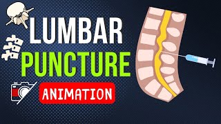 🎬 LUMBAR PUNCTURE LP  SPINAL TAP  TECHNIQUE  ANATOMY  SAMPLE  ANIMATION [upl. by Ahsinhoj450]