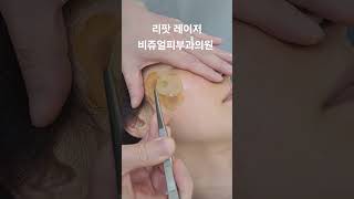 리팟 레이저 다발성 흑자 세종리팟 세종시리팟 reepot lentigo multiplelentigo 청주리팟 공주리팟 대전리팟 오창리팟 오송리팟 부여리팟 [upl. by Deedahs]