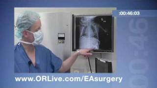 ORLive Express  Esophageal Atresia Surgery [upl. by Ymirej]