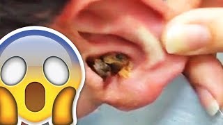 EAR WAX REMOVAL COMPILATION 1 [upl. by Isdnyl]