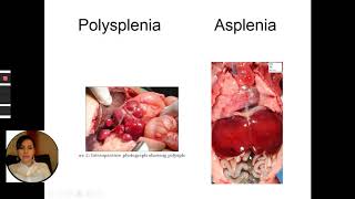 Fetal isomerismHeterotaxy syndromeFetal echocardiography in Azeri language [upl. by Zerlina]