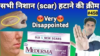 Mederma cream  mederma for acne scars  mederma advanced scar gel review [upl. by Idell]