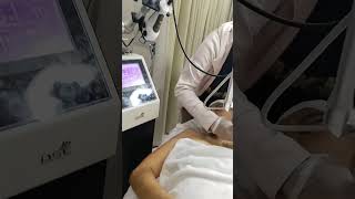 CO2 Laser Treatment for warts removal shortvideos subscribe [upl. by Adnohsed]