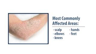 Common Skin Disorders Eczema amp Psoriasis [upl. by Bathelda]