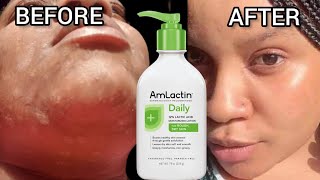 Even TONE skin✨AmLactin Daily 12 lactic Acid MoisturiZing lotion 2023ReviewRoughdrySkinspotless [upl. by Ardnua]