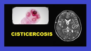 ¿Qué es la CISTICERCOSIS  Curso de Helmintología [upl. by Idelia497]