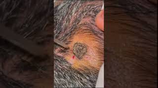 Seborrheic Keratosis Removal by Electrocautery [upl. by Ike]