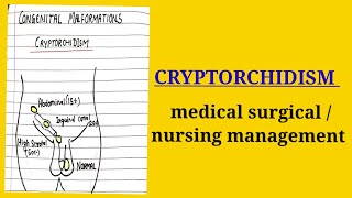 cryptorchidismmedical surgical topic nursing course [upl. by Jamie]