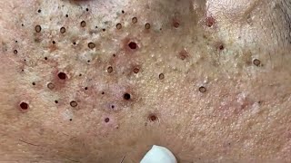 Fatty Acne and Blackheads at Sac Dep Spa [upl. by Seta563]