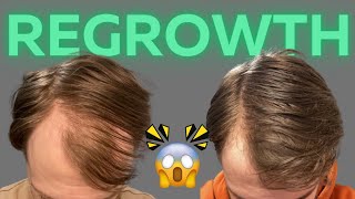 This Is How I Have Been Regrowing My Hair Loss [upl. by Nicoline]