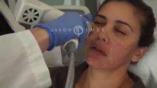 Syneron Profound Microneedling with Radiofrequency  Skin Facial Tightening and Lifting [upl. by Arahas]