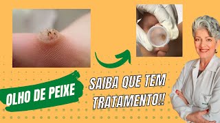 Olho De Peixe  Saiba Como Tratar [upl. by Ellehcsor]