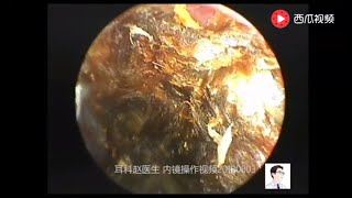 Endoscopic treatment of external auditory canal cholesteatoma external foreign body 10 minutes [upl. by Aliza]