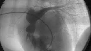 Pulmonic Stenosis Video [upl. by Ahselat]