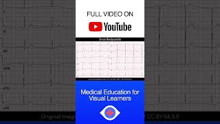 Sinus Bradycardia ECG shorts [upl. by Irakab]