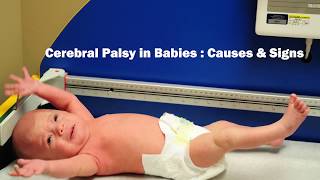 What are the main causes amp signs of Cerebral Palsy in babies  Dr Vykunta Raju K N [upl. by Kanor]