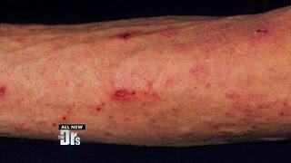 Scabies from the Gym [upl. by Kreitman]