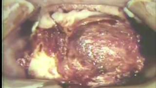 Removal of Large Ameloblastoma of Mandible [upl. by Allenod]