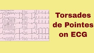 Torsade de Pointes on ECG [upl. by Jerusalem760]