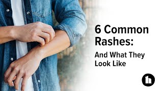 6 Common Rashes And What They Look Like  Healthline [upl. by Yrehc]