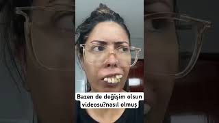 Değişim nasıl laminediş zirkonia dentistry implant [upl. by Adnoraj]