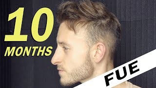 FUE Hair Transplant 10 Months post op Istanbul Turkey [upl. by Gnort764]