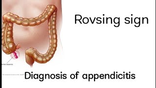 Rovsing sign diagnosis of appendicitisConfirmation of appendicitis Medschool1234 appendicitis [upl. by Asilegna]