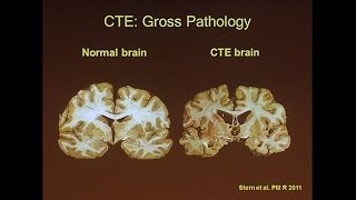 Chronic Traumatic Encephalopathy [upl. by Enamrej]