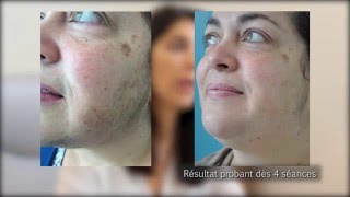 Epilation du visage avec lasers dermatologiques par le Dr Phryné COUTANTFOULC à Nantes 44 [upl. by Ynes137]