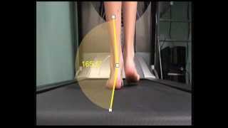 Over Pronation and how this is measured in walking [upl. by Tyrus]