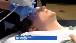 Live Demo of the BTL EXILIS on the Good Day Pa TV Show [upl. by Gauthier]